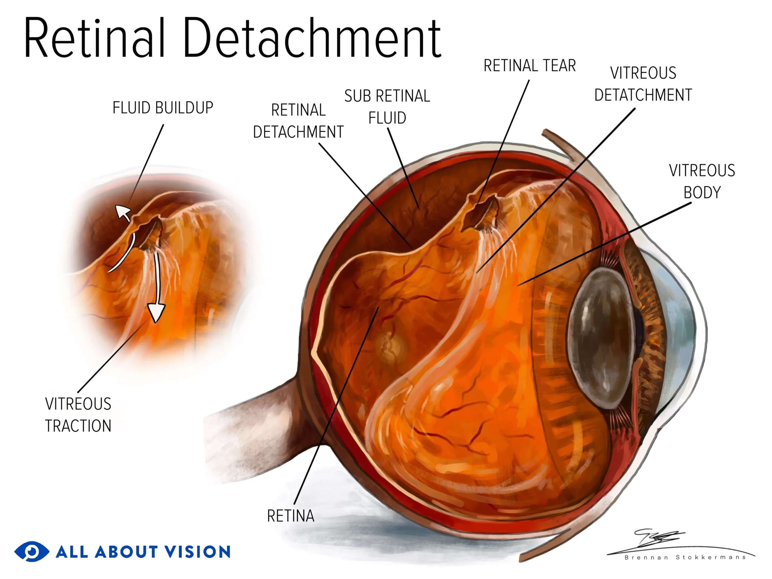 What is ratina detachment ?